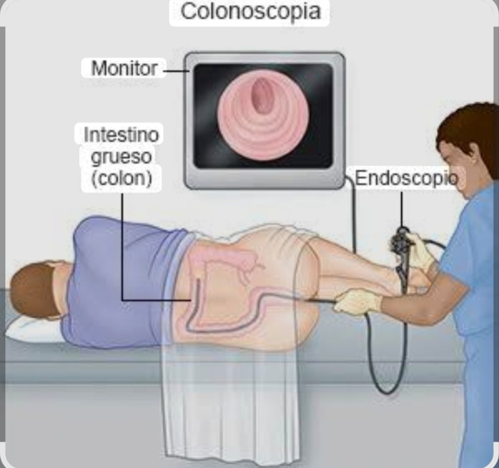 Coloroscopia Colonoscopia y Colostomía: lo que debes saber para cuidar tu salud ...